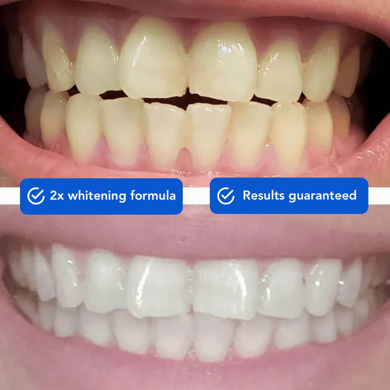 DiamondSeries® Wireless Teeth Whitening Kit with Hydroxyapatite & Self-Sanitizing Charging Case